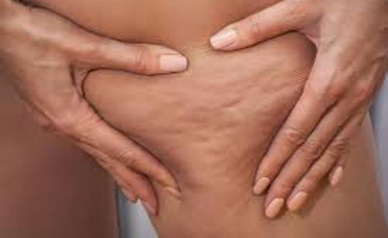 Lipedema: a doença confundida com obesidade que atinge principalmente mulheres