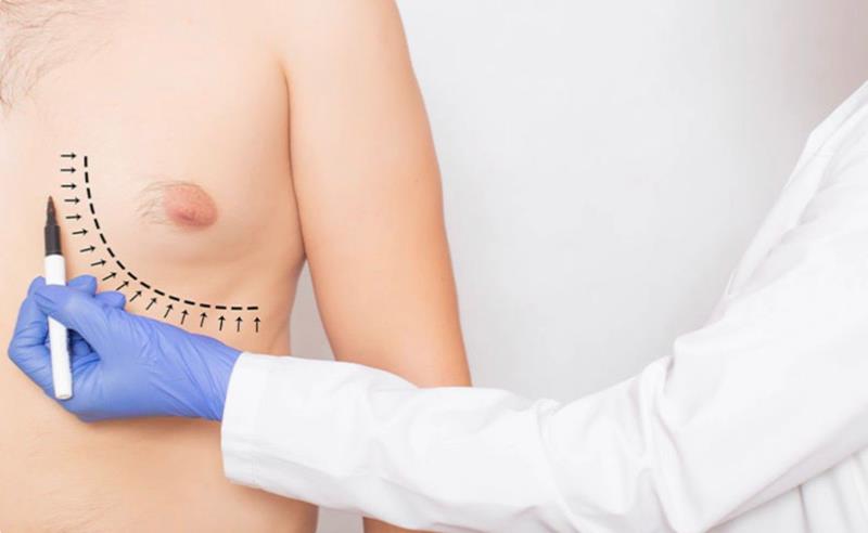 Dr. Octávio Curi Frascareli – Ginecomastia em Maringá: entenda o que é e como é feita a cirurgia