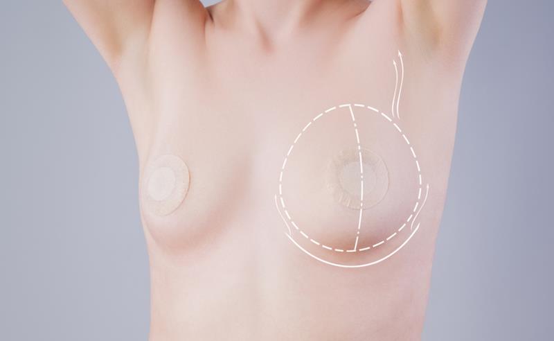 Dr. Octávio Curi Frascareli: Mastopexia em Maringá, elevação das mamas com ou sem prótese