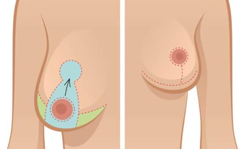 Dr. Octávio Curi Frascareli: Redução de Mamas em Maringá: alívio, proporção e bem-estar