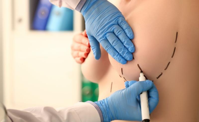 Dr. Octávio Curi Frascareli: Redução de Mamas em Maringá: alívio, proporção e bem-estar