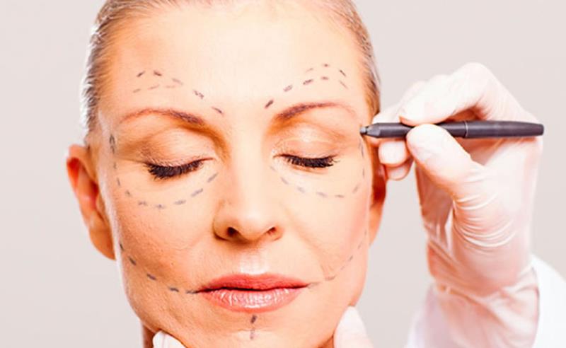 Dr. Octávio Curi Frascareli: Ritidoplastia (Lifting Facial) em Maringá: flacidez e rejuvenescimento com naturalidade