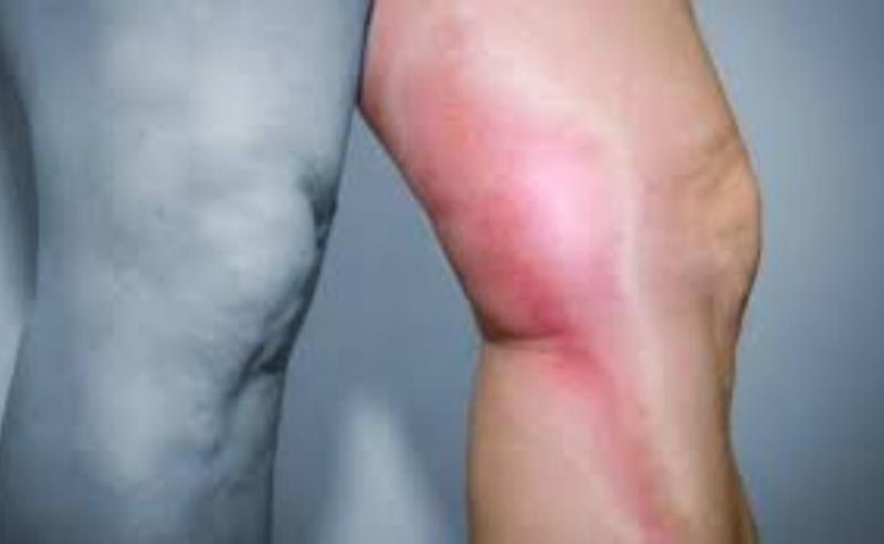 Trombose: 9 mitos e verdades sobre a doença silenciosa