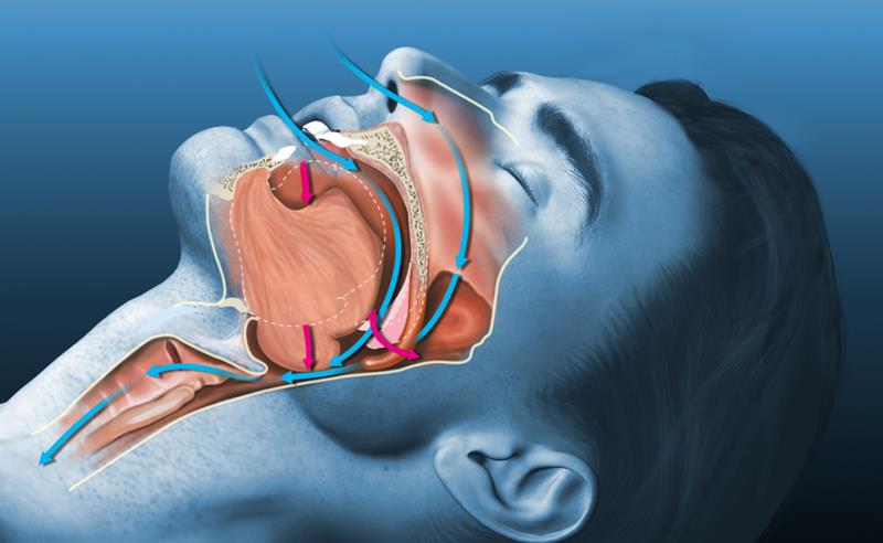 Clínica Pro-Result: Apneia do Sono: sintomas, riscos, diagnóstico e tratamentos atuais