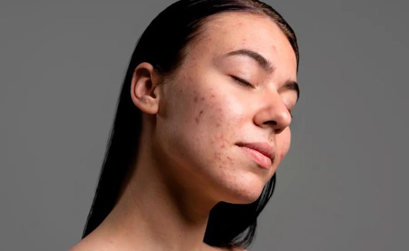 Clínica Pro-Result: Lúpus: sinais, diagnóstico e os tratamentos que mudaram o paradigma