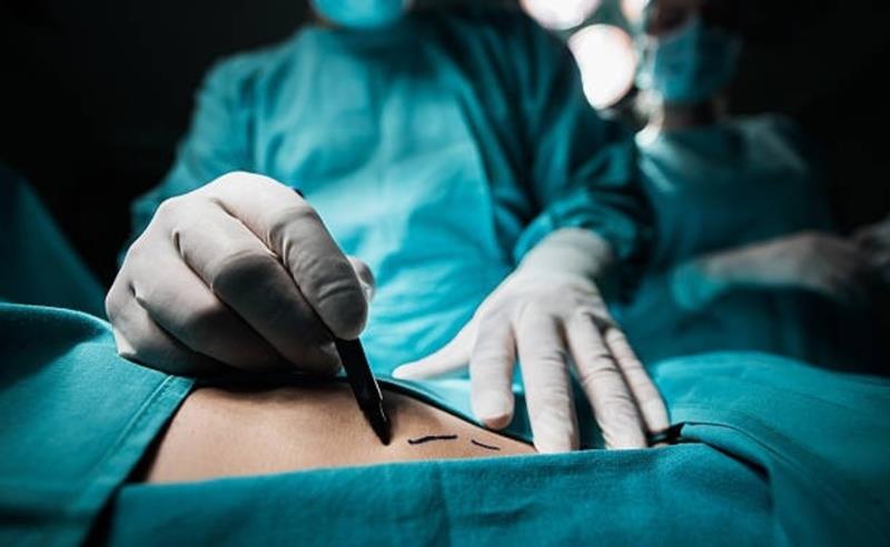 A cirurgia plástica ficou menos traumática? O que está mudando na lipoaspiração e na expectativa das pacientes